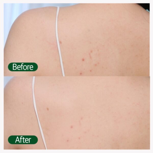 Happy Bath Deep Clean Acne Body Wash [#180g #900g] - Image 4